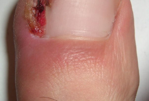 Nail Surgery including ingrown toenails & others