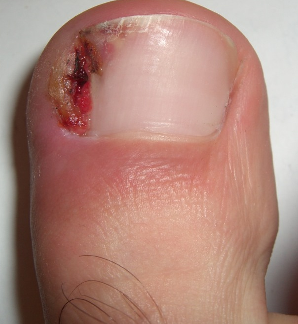 Nail Surgery including ingrown toenails & others