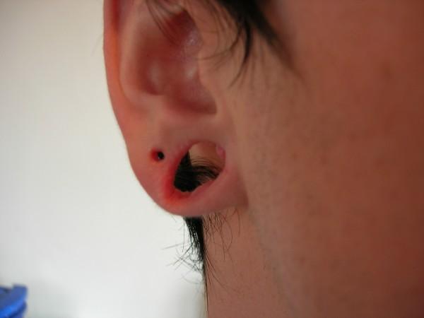 Ear piercing deformity repairs