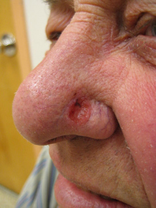 basal cell carcinoma or nose image from https://commons.wikimedia.org/wiki/File:Basal_cell_carcinoma2.JPG
