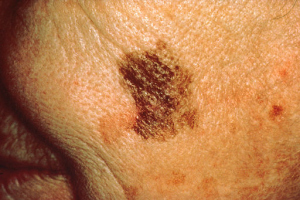 melanoma image from https://commons.wikimedia.org/wiki/File:Melanoma_with_diameter_change.jpg